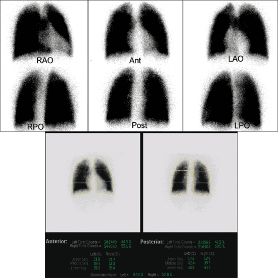 Lung Perfusion Scan